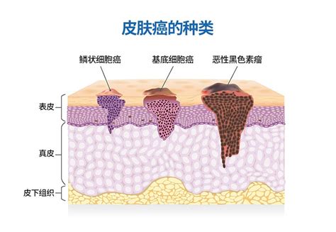 皮膚癌|皮肤癌